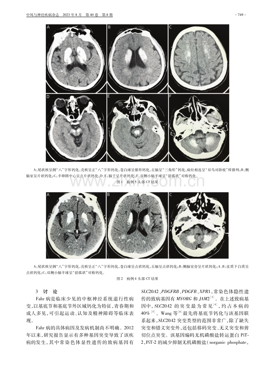 Fahr病9例临床分析.pdf_第3页