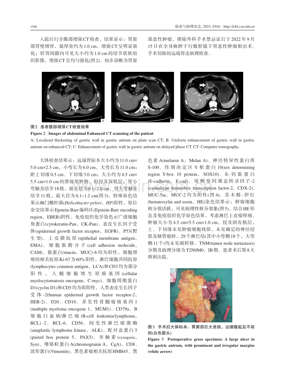 EB病毒阴性胃淋巴上皮瘤样癌1例并文献复习.pdf_第3页