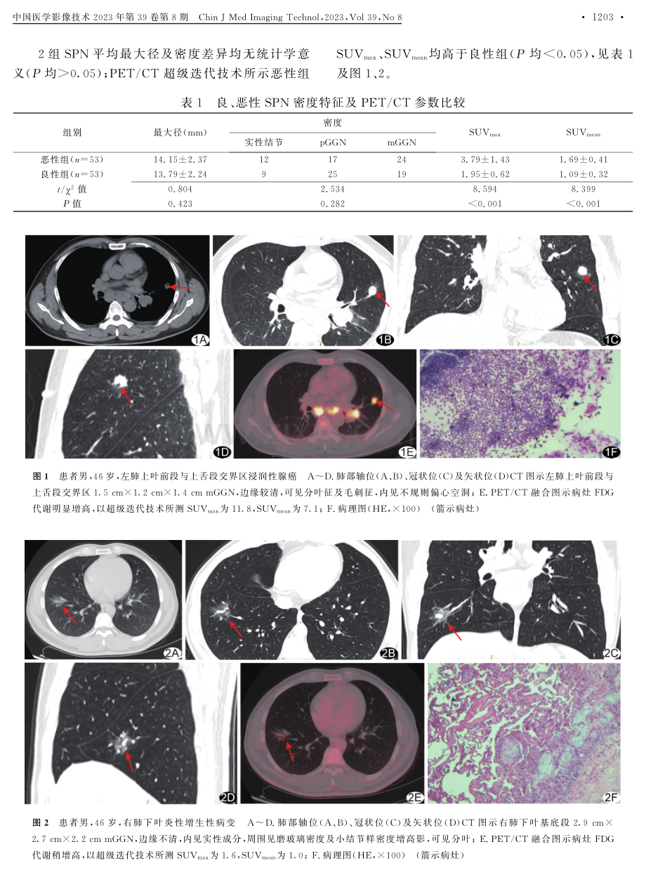 PET_CT超级迭代技术诊断孤立性肺结节.pdf_第3页