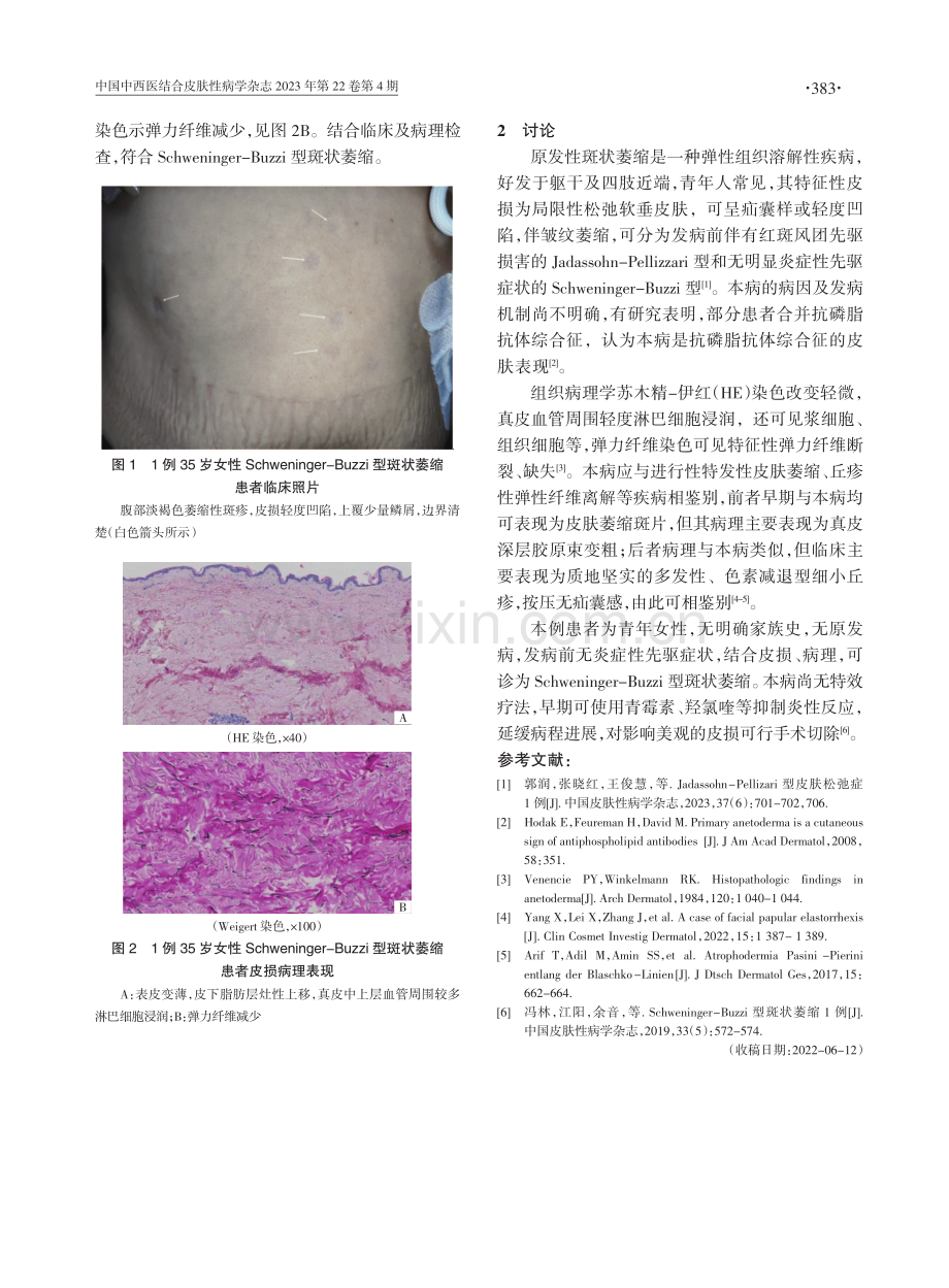 Schweninger-Buzzi型斑状萎缩1例诊治体会.pdf_第2页