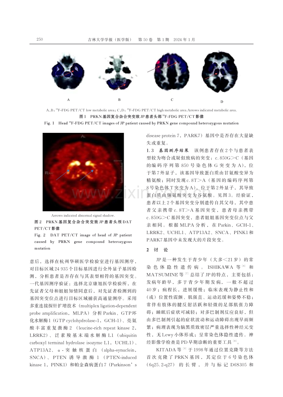 PRKN基因复合杂合突变致青少年型帕金森病1例报告及文献复习.pdf_第3页