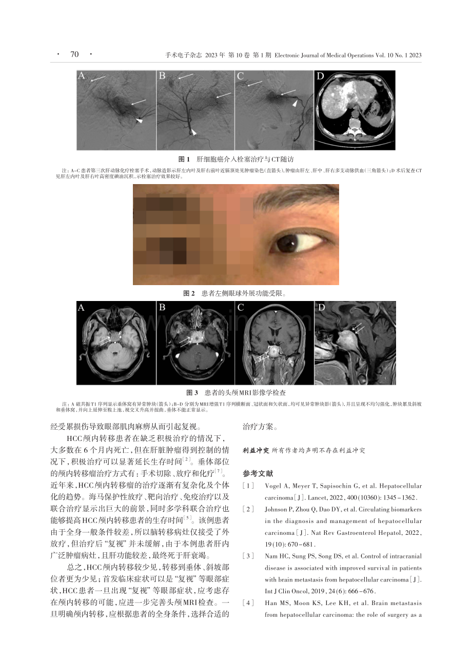 以“复视”为首发症状的肝细胞癌颅内转移1例.pdf_第2页