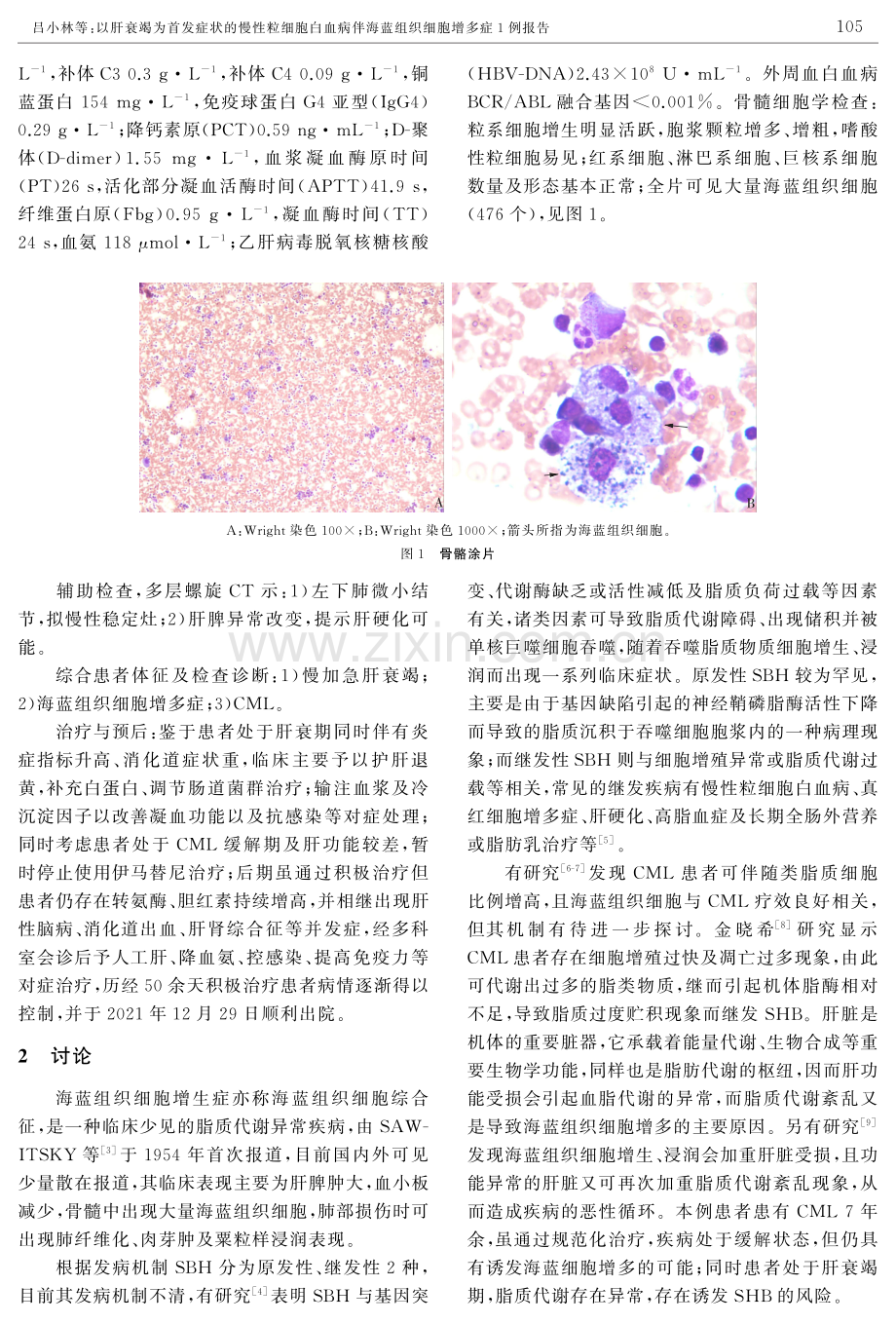 以肝衰竭为首发症状的慢性粒细胞白血病伴海蓝组织细胞增多症1例报告.pdf_第2页