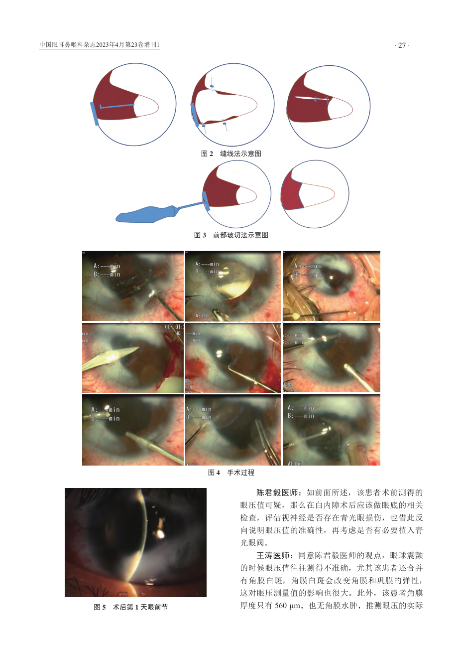 白内障合并角膜巨大白斑手术治疗1例.pdf_第3页