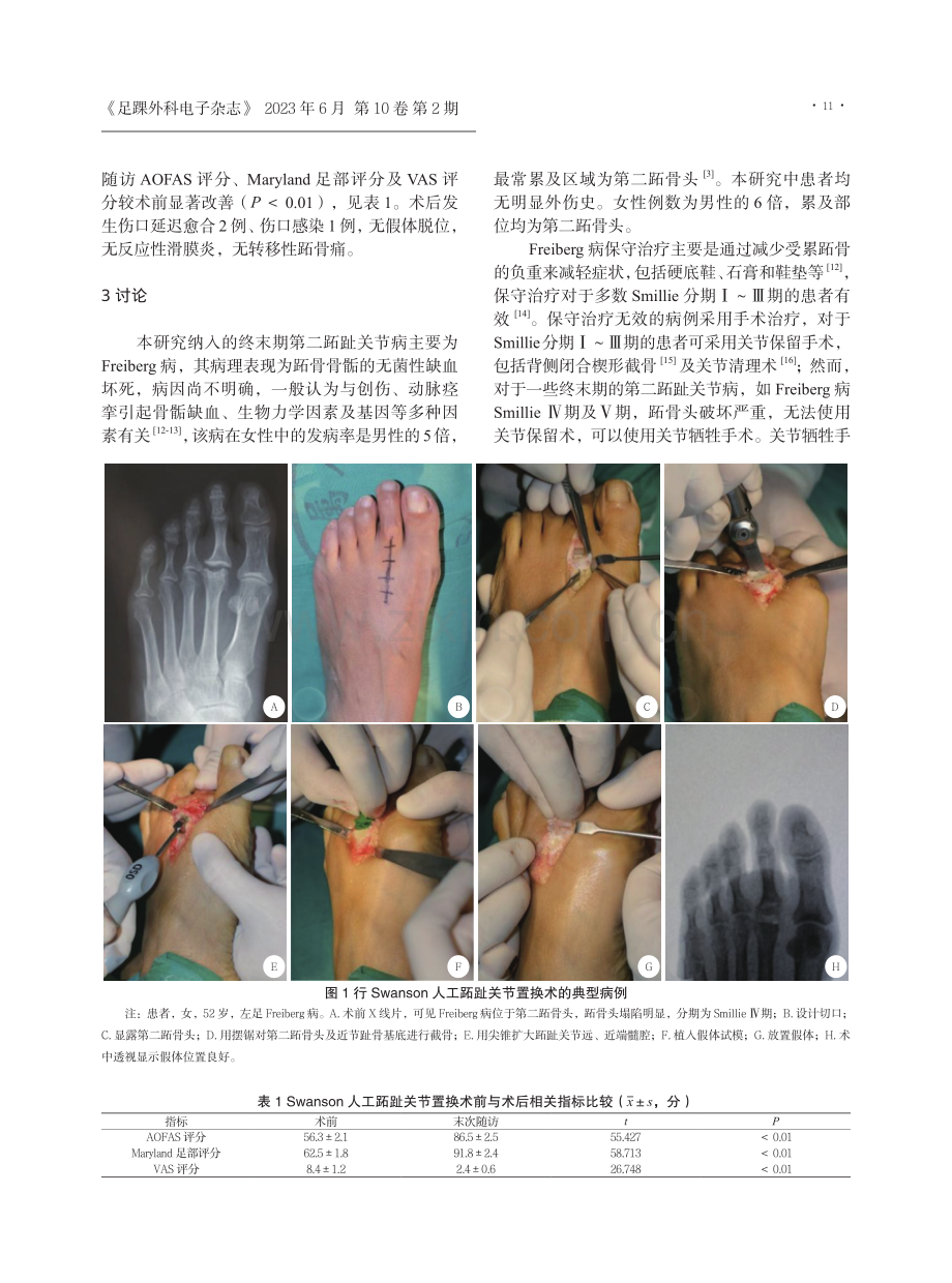 Swanson人工跖趾关节置换术治疗终末期第二跖趾关节病.pdf_第3页