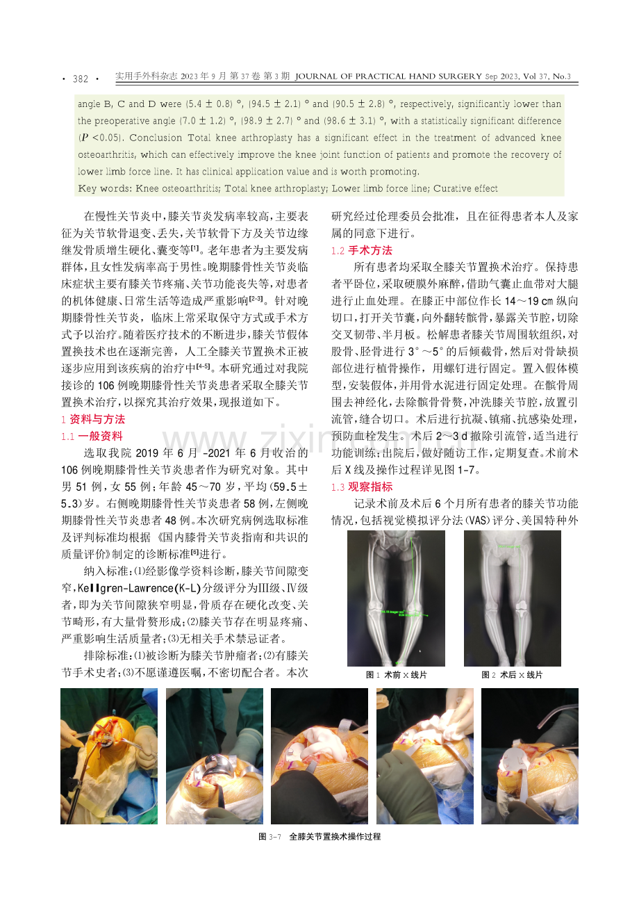 TKA对晚期膝骨性关节炎临床疗效和下肢力线的影响.pdf_第2页
