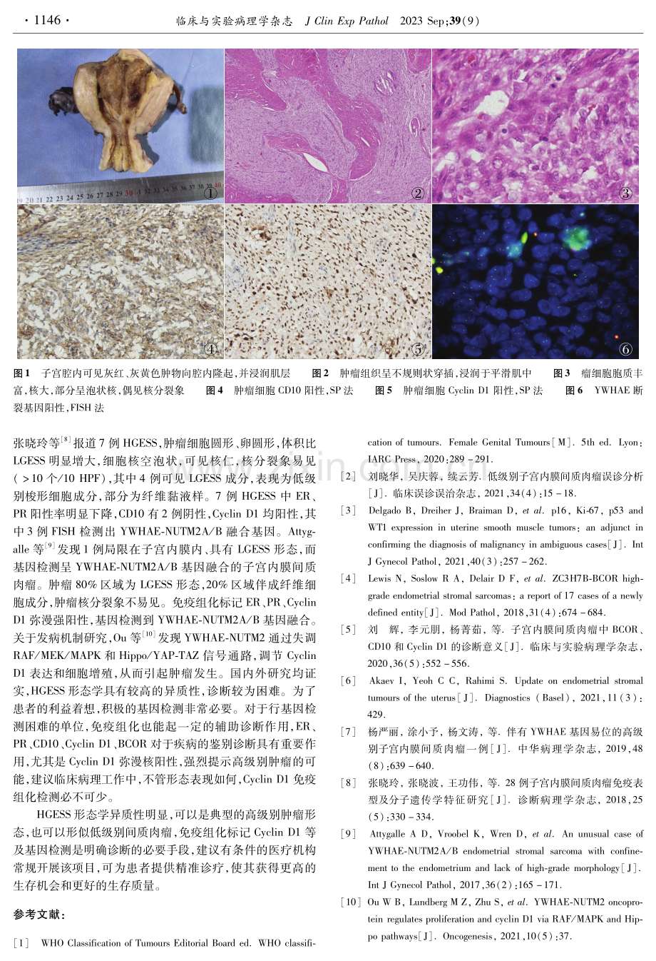 YWHAE基因易位的高级别子宫内膜间质肉瘤1例.pdf_第2页