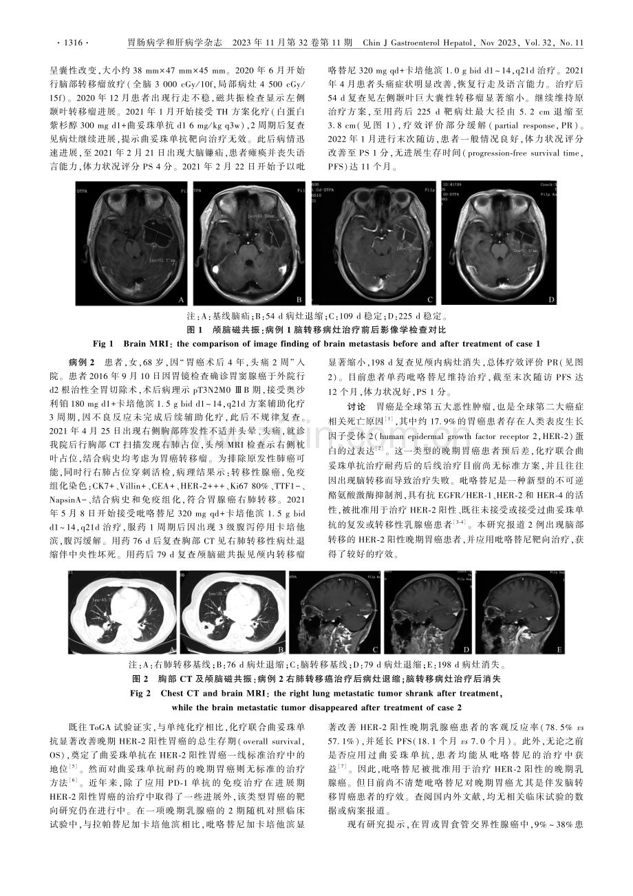 吡咯替尼后线治疗HER-2阳性胃癌伴脑转移患者2例报道.pdf_第2页