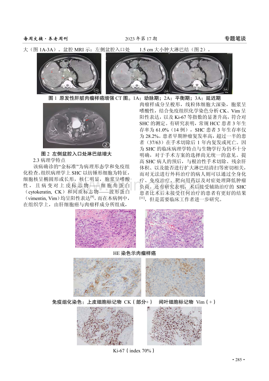 丙型肝炎合并肝脏肉瘤样癌1例及文献复习.pdf_第2页