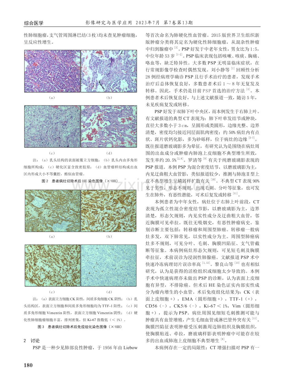 硬化性肺细胞瘤1例不典型CT表现.pdf_第2页