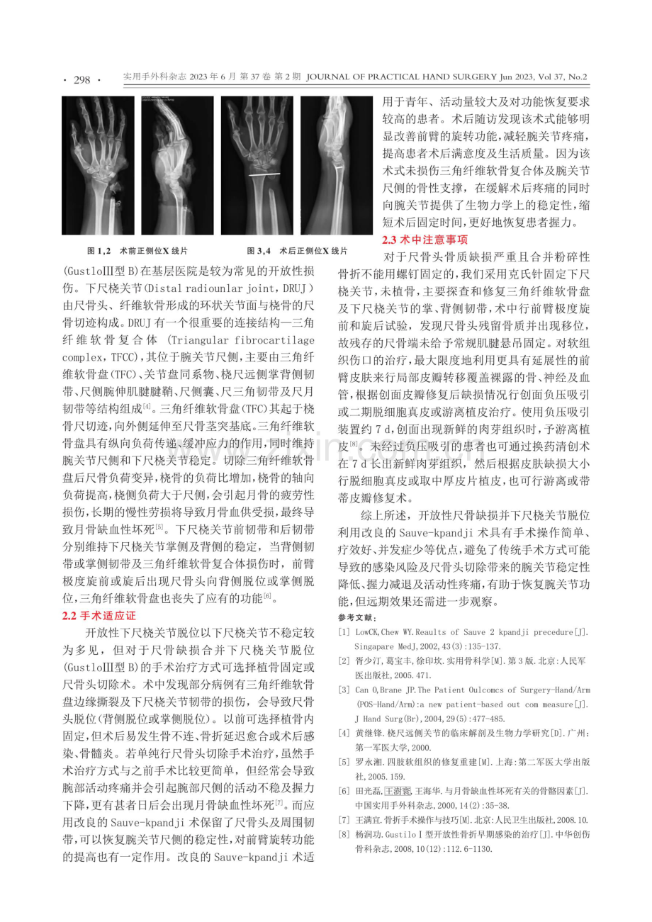 应用改良的Sauve-kpandji术治疗尺骨远端开放性骨缺损并下尺桡关节脱位1例.pdf_第2页