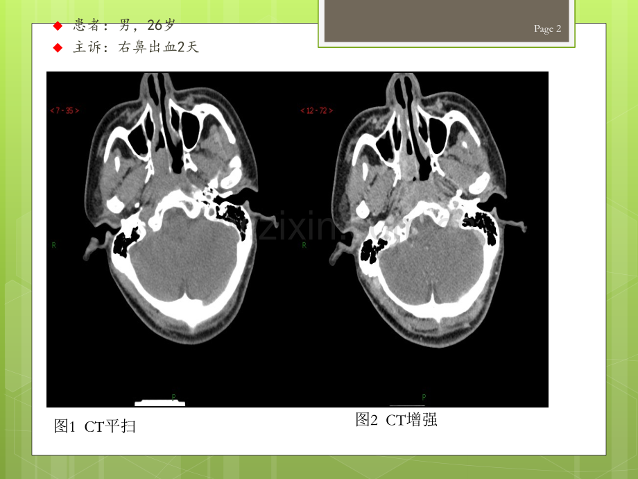 鼻咽纤维血管瘤的影像表现及临床.ppt_第2页