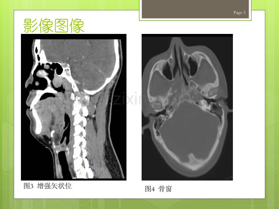 鼻咽纤维血管瘤的影像表现及临床.ppt_第3页