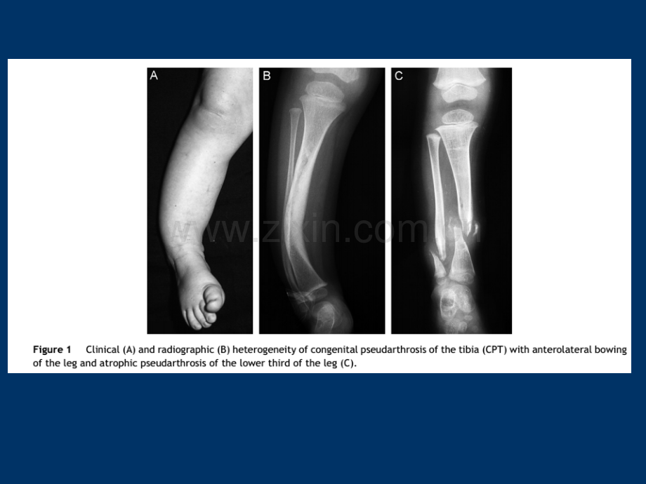先天性胫骨假关节课件.ppt_第1页