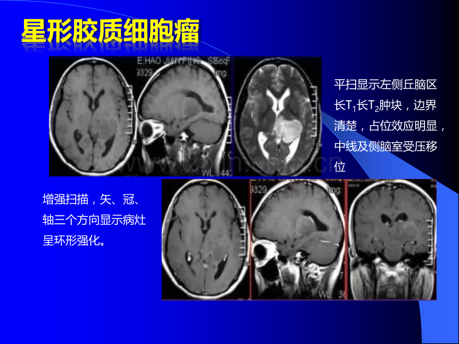 脑基本病变的MRI表现ppt课件.pptx_第3页