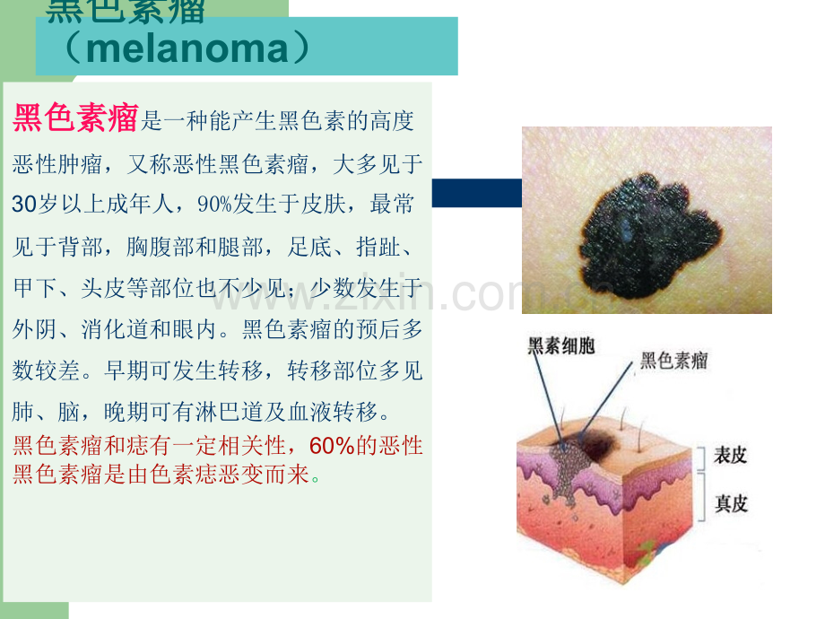 恶性黑色素瘤患者的护理.ppt_第3页