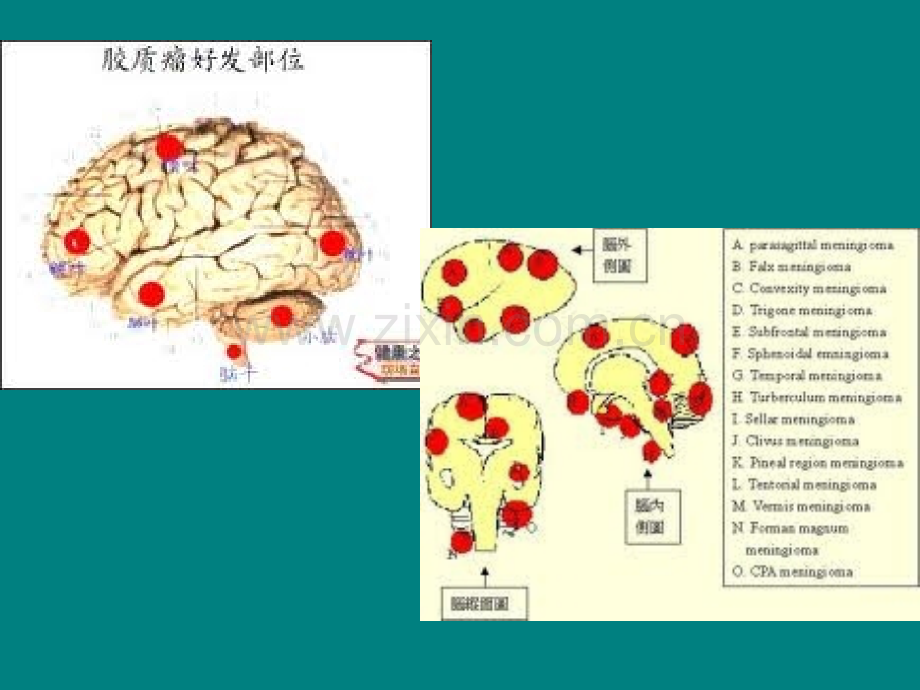 常见脑肿瘤的影像诊断ppt课件.ppt_第3页