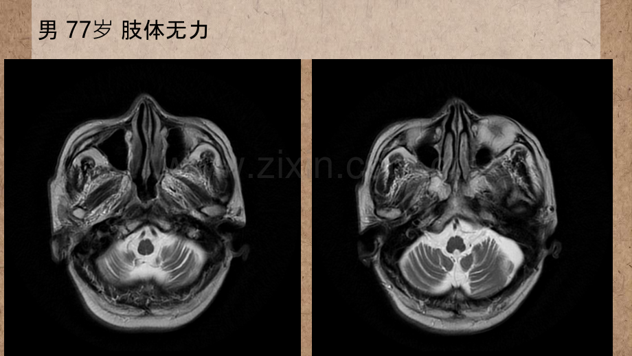 橄榄桥脑小脑萎缩的影像学诊断.ppt_第1页