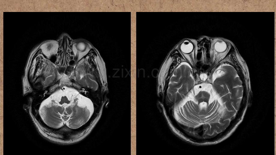 橄榄桥脑小脑萎缩的影像学诊断.ppt_第2页