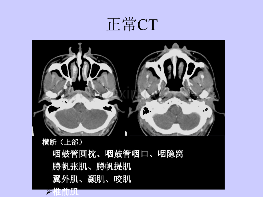 鼻咽肿瘤ppt课件.ppt_第3页