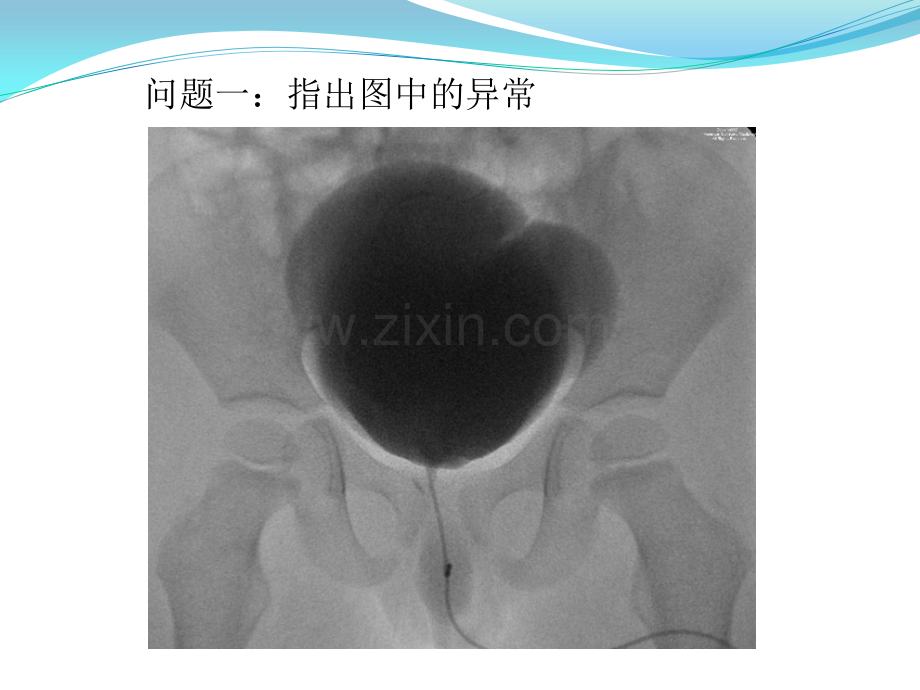 重复膀胱-影像学病例讨论PPT课件.pptx_第3页