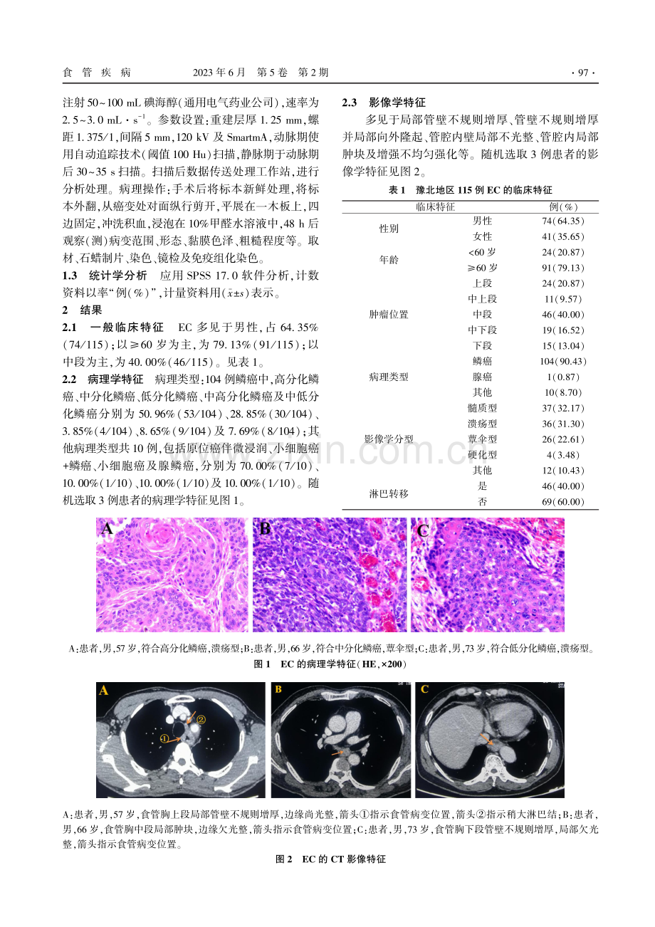 豫北地区115例食管癌临床特征分析.pdf_第2页