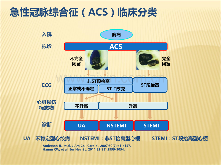 NSTE-ACS诊断标准和治疗原则解读.ppt_第3页