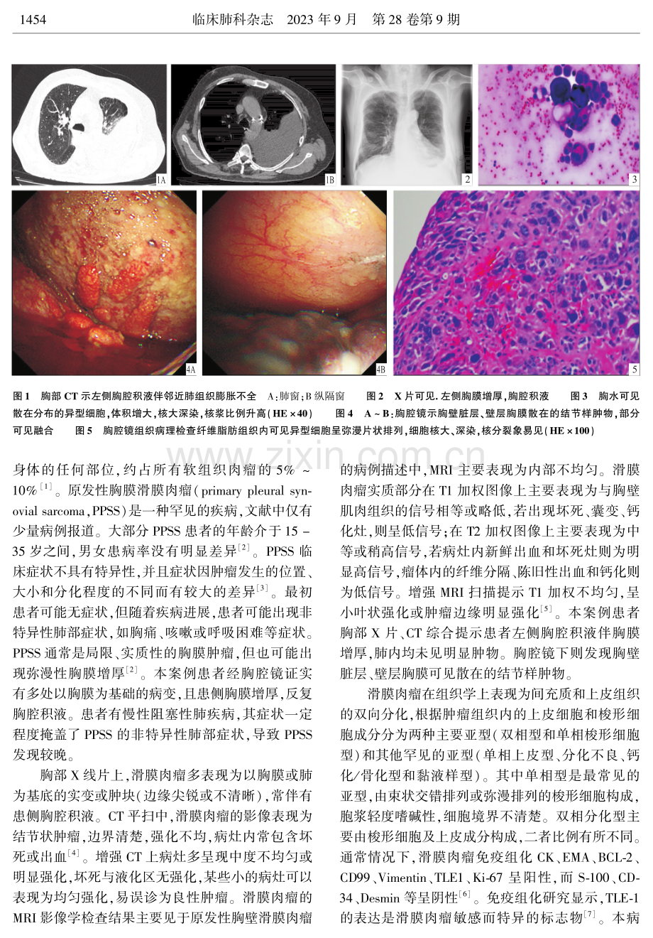 原发性胸膜滑膜肉瘤1例.pdf_第2页