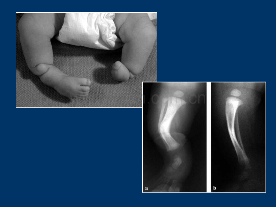 先天性胫骨假关节..ppt_第3页