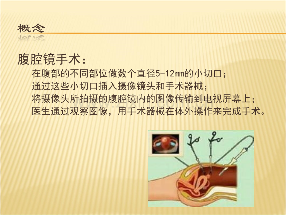 腹腔镜围手术期护理.ppt_第3页