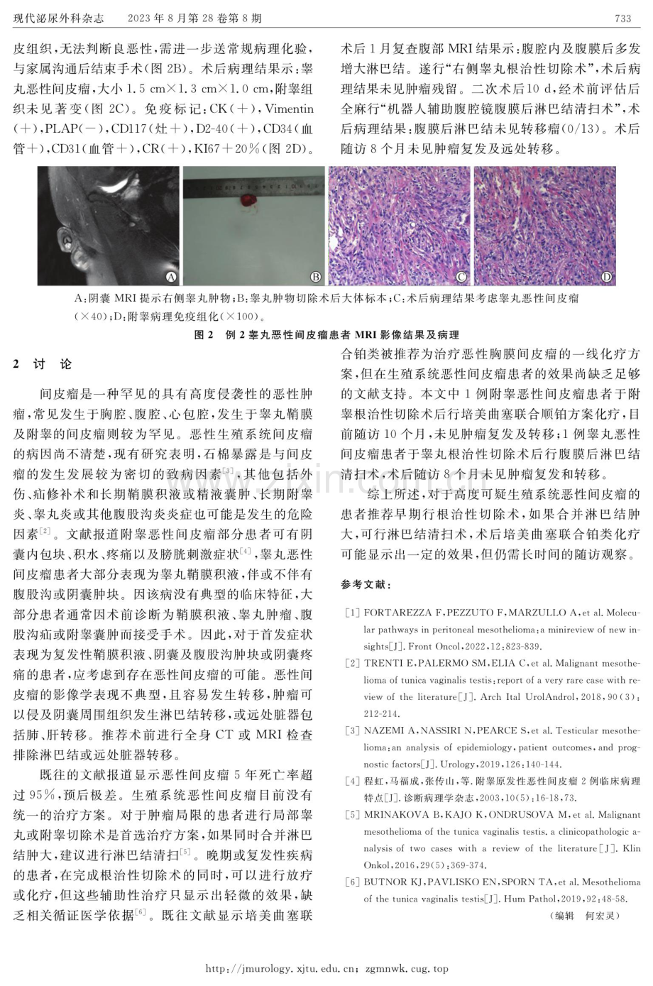 原发性生殖系统恶性间皮瘤2例报告.pdf_第2页