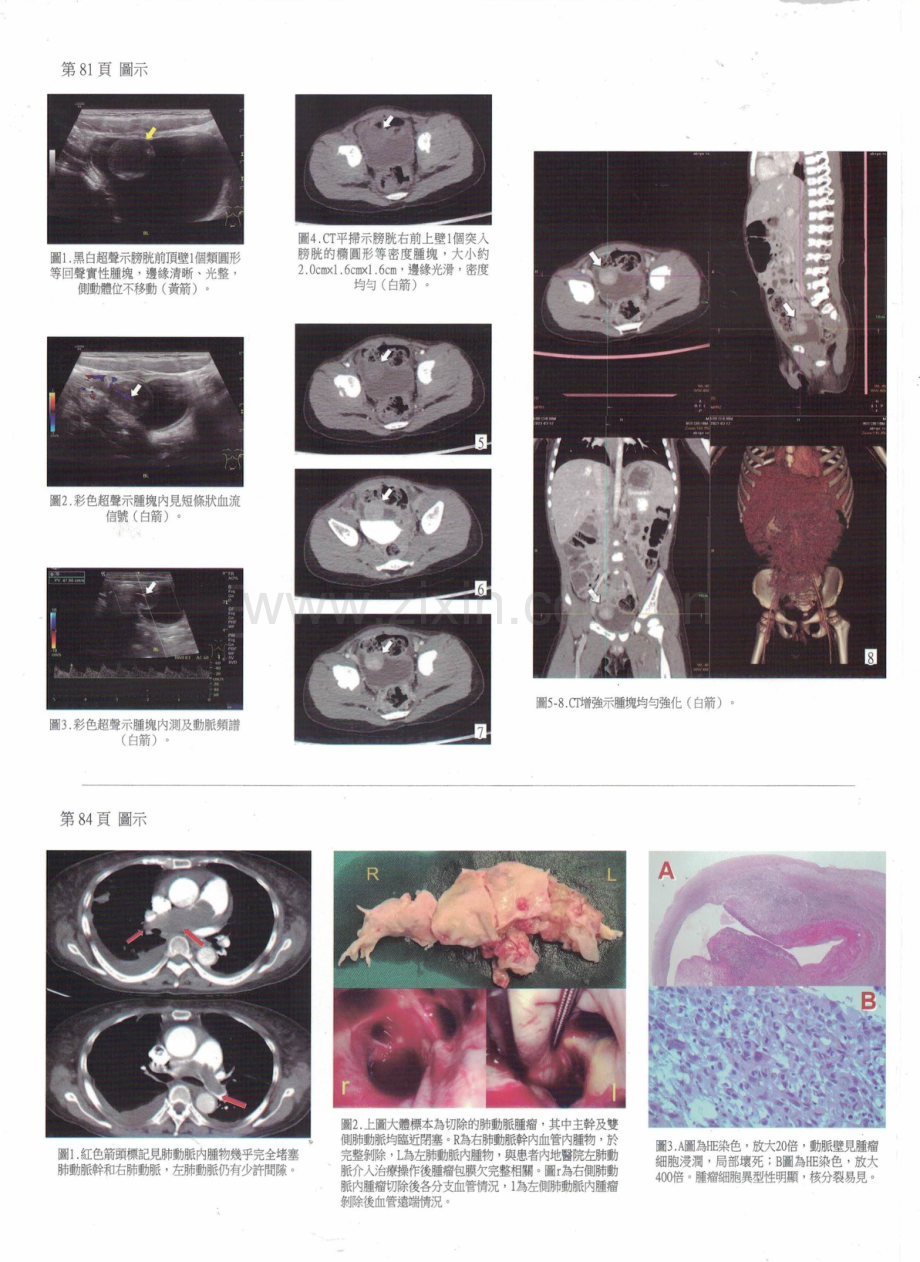 原發性肺動脈肉瘤1例.pdf_第3页
