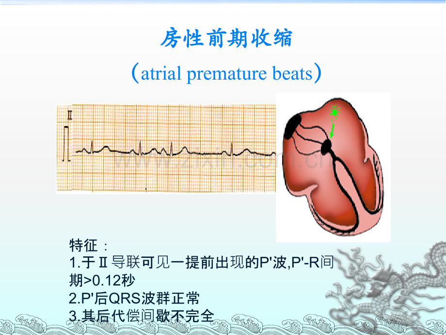 常见心律失常的ECG表现及药物治疗.ppt_第3页