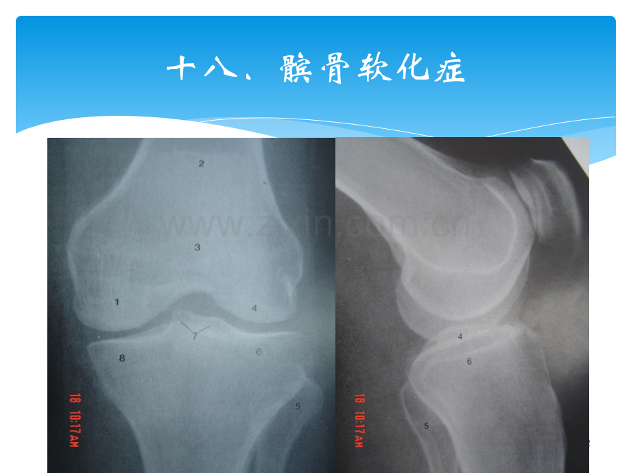 髌骨软骨软化症的康复ppt课件.ppt_第2页