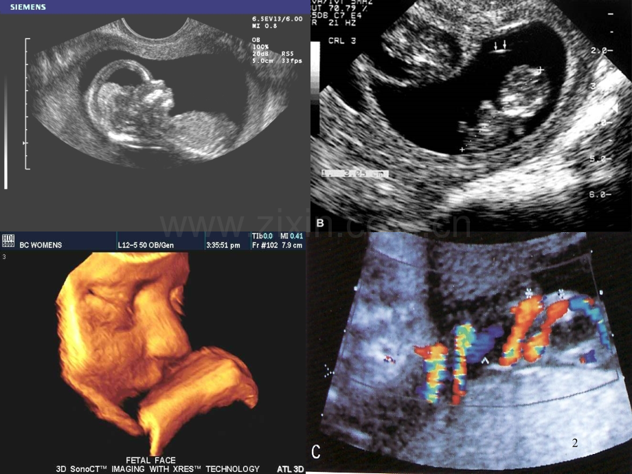 产科超声幻灯PPT课件.ppt_第2页
