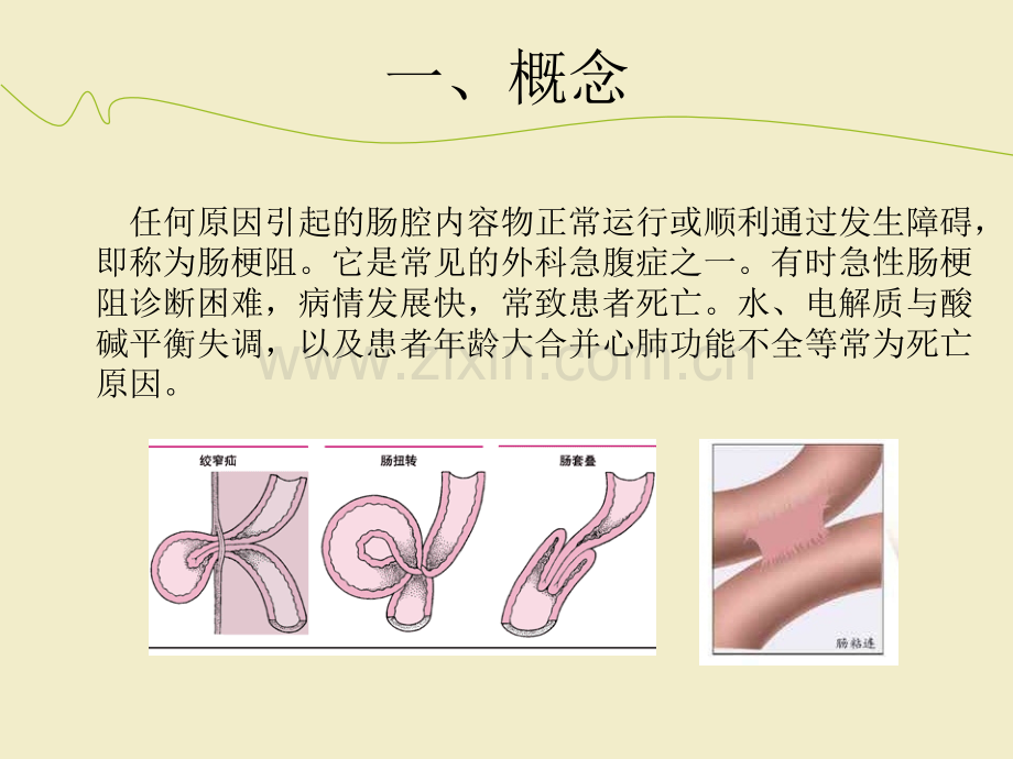 肠梗阻护理常规ppt课件(1).ppt_第2页