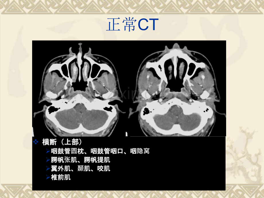 鼻咽肿瘤.ppt_第3页