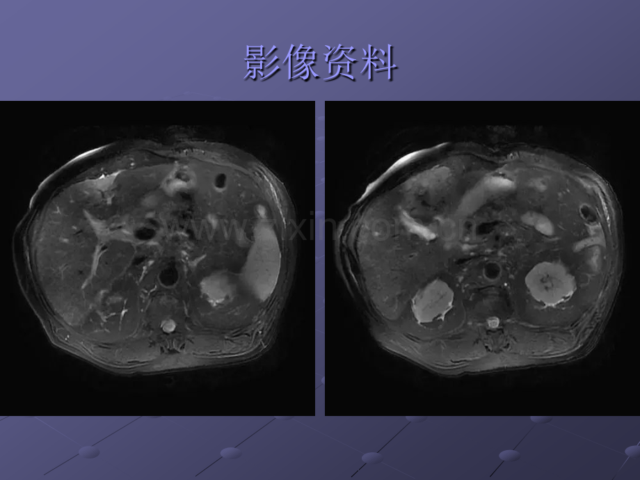 肝腺瘤、FNH、膀胱癌肉瘤ppt课件.ppt_第3页