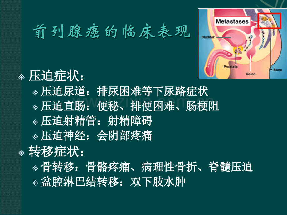 腹腔镜前列腺癌根治术.ppt_第3页