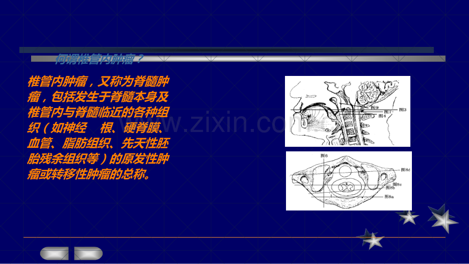 常见椎管内肿瘤及MRI表现ppt课件.ppt_第2页