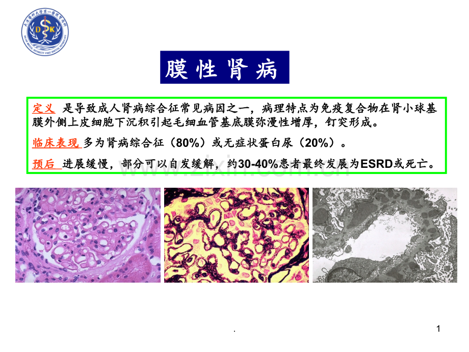 KDIQO指南解读膜性肾病治疗PPT课件.ppt_第1页