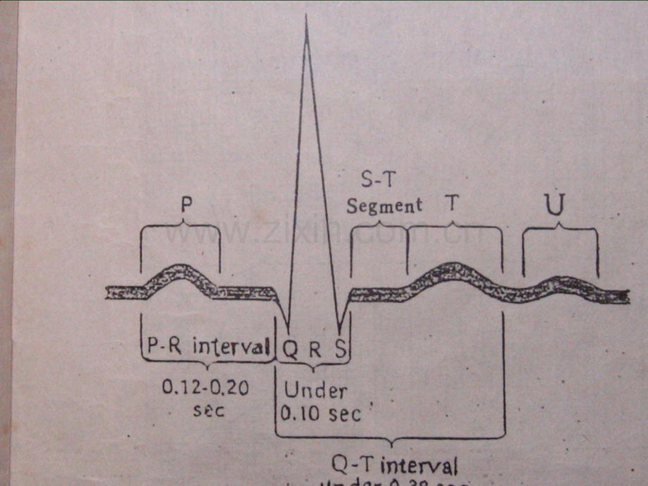 常见心电图诊断.ppt_第3页