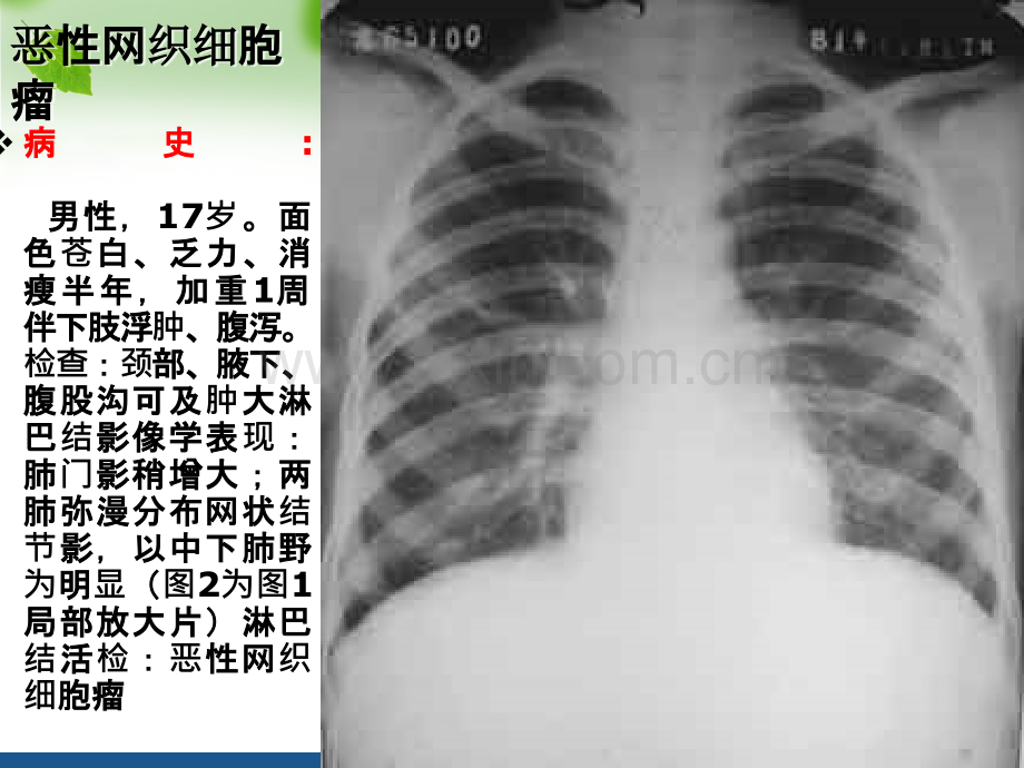 肺癌诊断肺癌诊断ppt课件.ppt_第2页