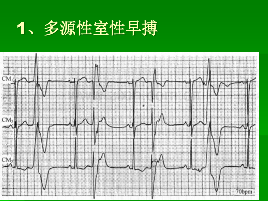 恶性心律失常的鉴别及处理-护理ppt课件.ppt_第3页