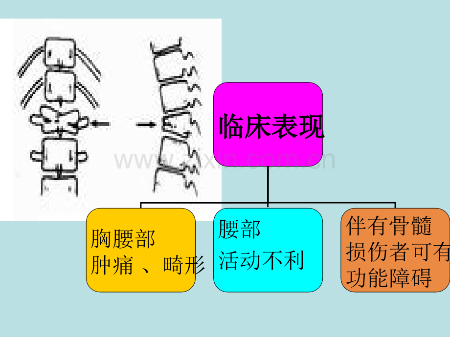 胸腰椎骨折的中医诊疗.ppt_第2页