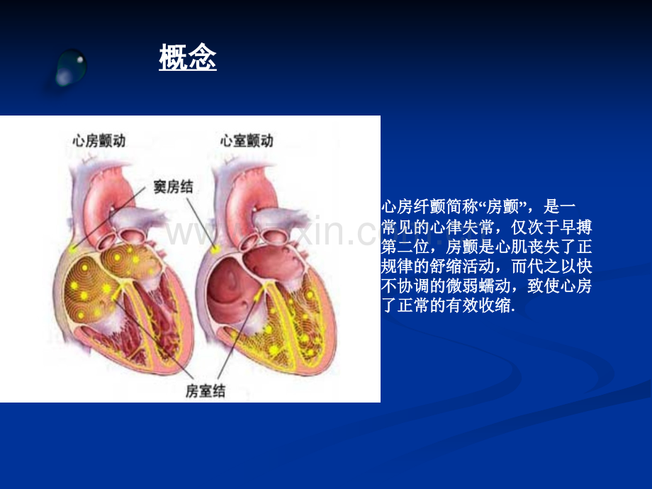 房颤及左心耳封堵.ppt_第2页