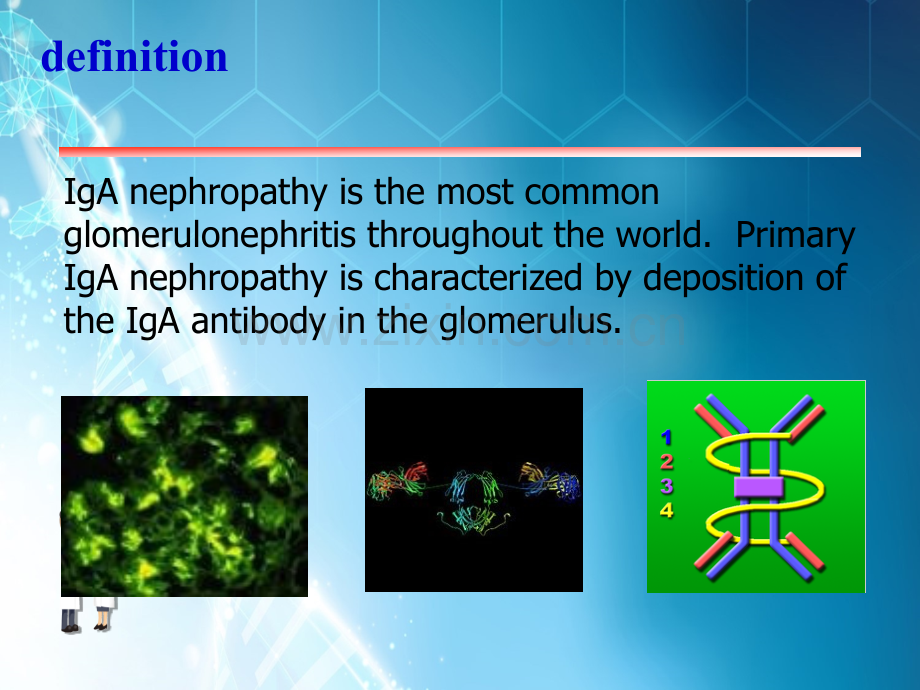 IgA肾病结合内科ppt课件.ppt_第2页