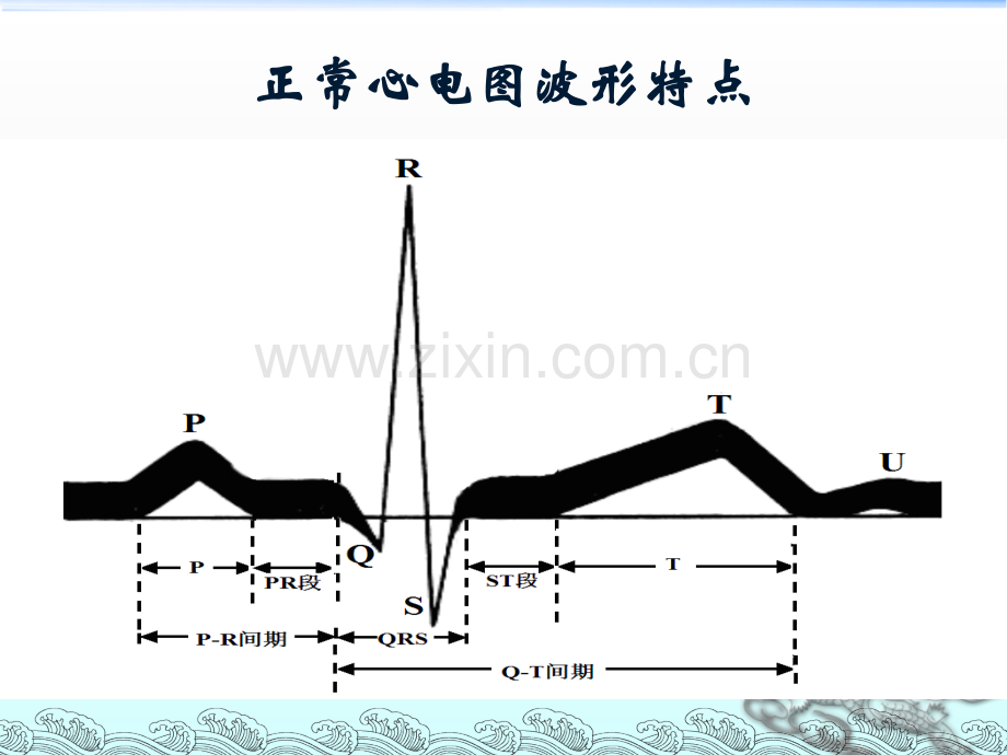 常见异常心电图的识别及处理ppt课件.ppt_第3页