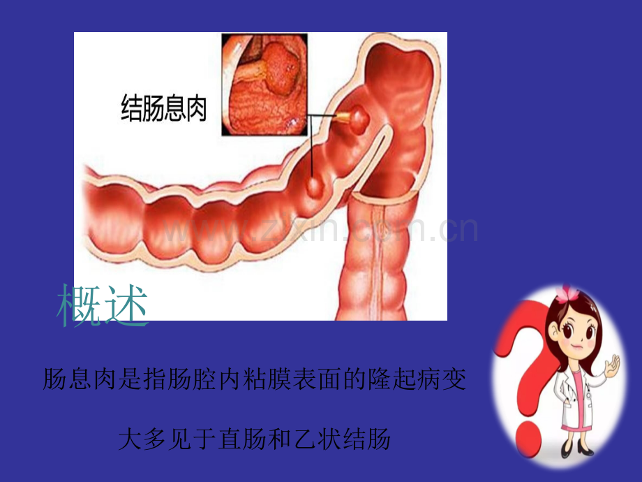 肠息肉的术前术后护理.ppt_第2页