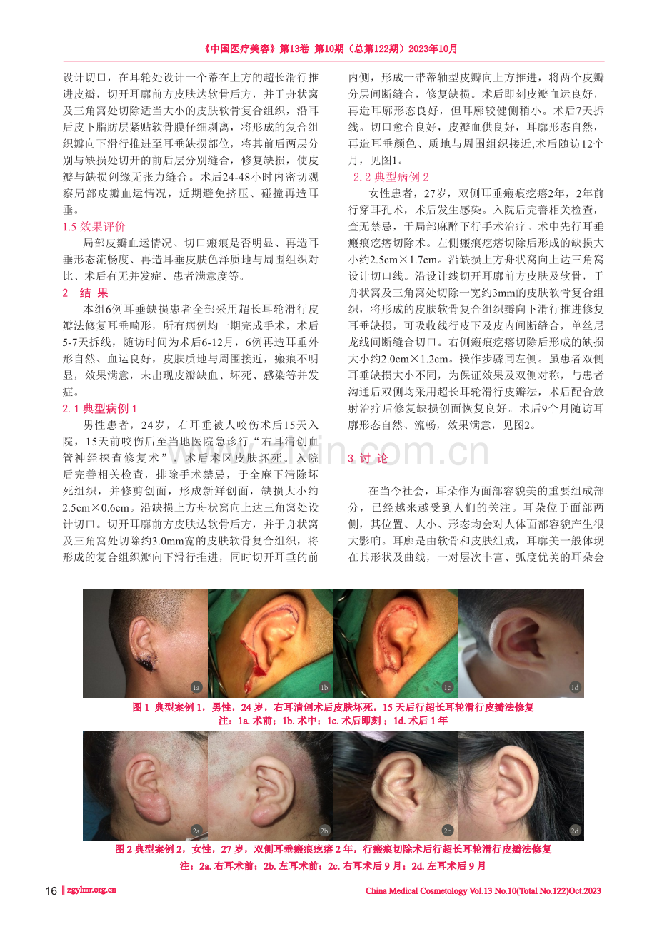 超长耳轮滑行皮瓣法修复耳垂缺损.pdf_第2页